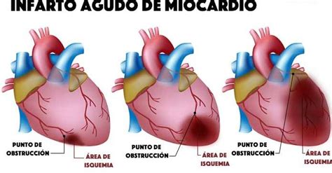 Conoce Sobre Las Enfermedades Del Sistema Circulatorio