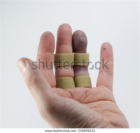 Bones Broken Finger Fixed Splint Stock Photo (Edit Now) 536898223