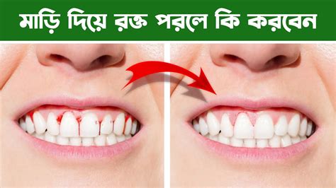 দাঁতের মাড়ি দিয়ে রক্ত পড়ার কারণ ও প্রতিকার Health Tips Bleeding