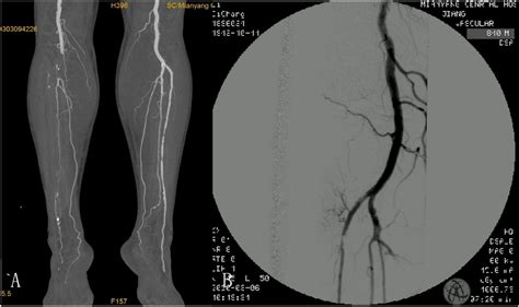 A The Angiogram Revealed Acute Thrombotic Occlusion Of The Above Knee