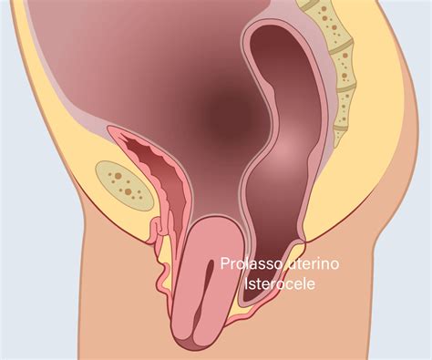 SINTOMI DEL PROLASSO UTERINO E Consigli Per La Diagnosi Precoce