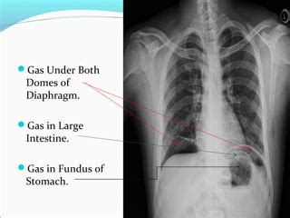 Gas Under Diaphragm - Final Year MB BS Lecture | PPT