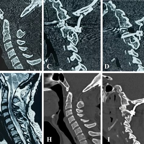 A After Cage Implantation Screws Were Inserted Below The Bilateral C2