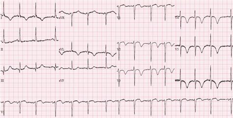 New-onset giant T-wave inversion with prolonged QT interval: shared by multiple pathologies ...