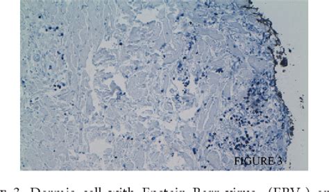 Figure 1 From A Rare Case Of Zosteriform Cutaneous Metastases From A Nasopharyngeal Carcinoma