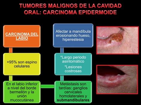 Tumores Malignos De La Cavidad Oral PPT