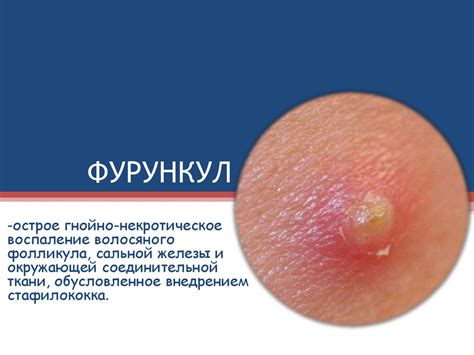 фурункул. Предрасполагающие факторы - презентация онлайн