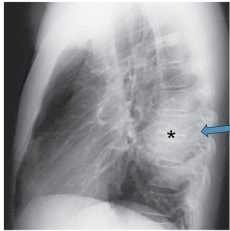 Radiology Chest Imaging Pathology Advanced Chest Imaging Flashcards