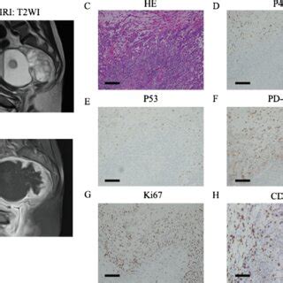 Results of imaging tests and pathological findings. A. MRI finding ...