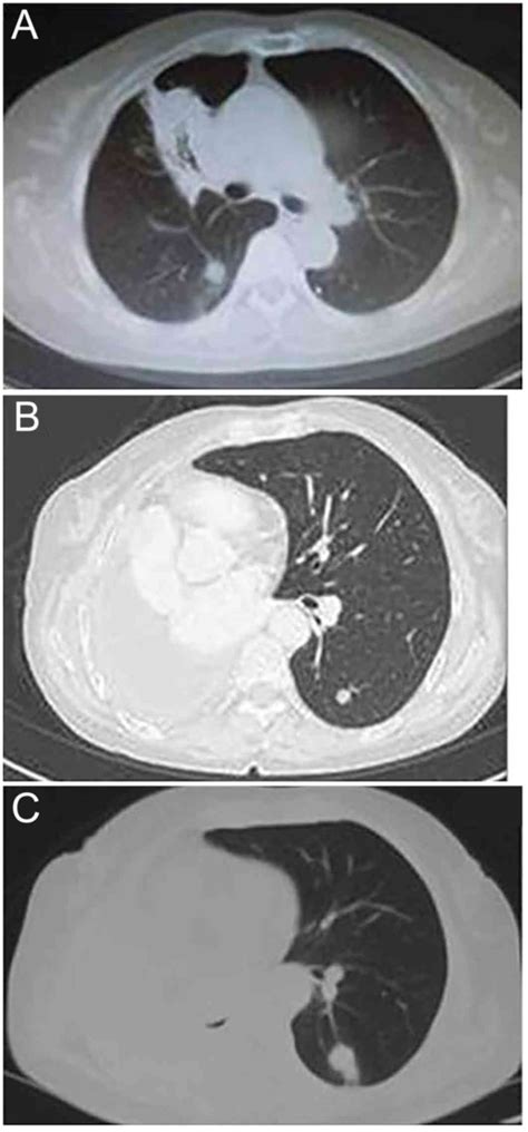 Primary Mucinous Adenocarcinoma Of The Lung A Case Report And Review