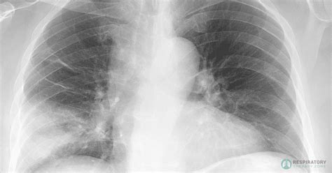 Chest X Ray Consolidation Vs Infiltrate