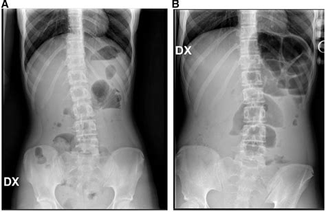 Laparoendoscopic Management Of Colonic Trichobezoar Causing Acute Large