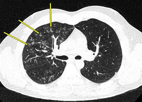 Tomodensitométrie thoracique dans le cadre d une pneumonie à