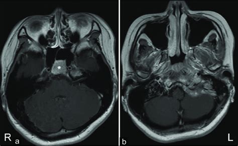 Preoperative Magnetic Resonance Imaging Findings Contrast Enhanced