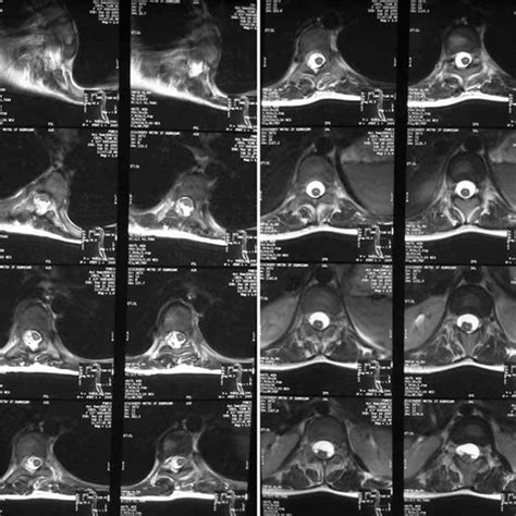 Magnetic resonance imaging (MRI) revealed syringomyelia. | Download ...