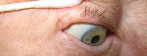 Basal Cell Carcinoma On Lower Eyelid