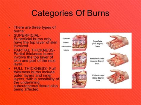 The Three Categories Of Burn