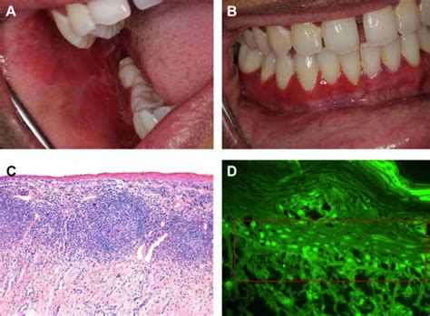 The Diagnostic Challenges Of Separating Chronic Ulcerative Stomatitis