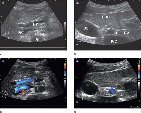 Common Hepatic Duct Ultrasound