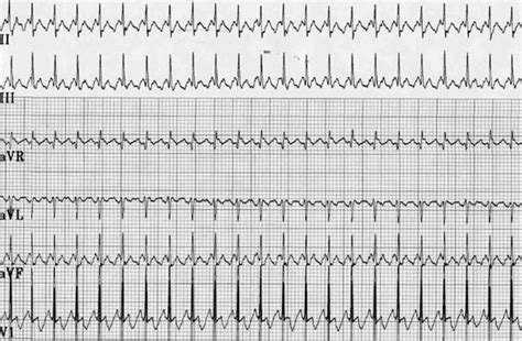 Atrial Flutter