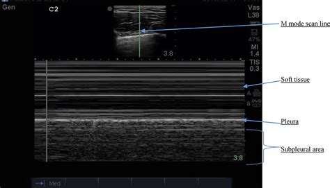 The Use Of M Mode Ultrasonography To Differentiate The Causes Of B