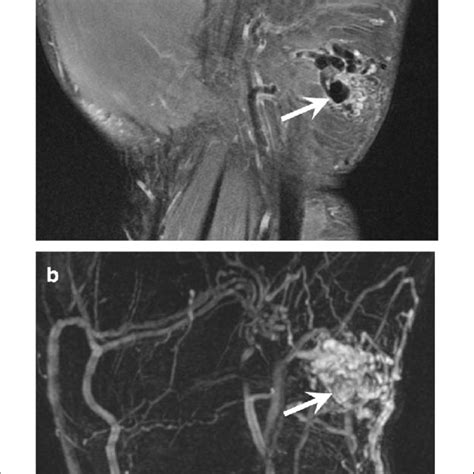 Stewart Treves Syndrome In A 78 Year Old Woman With A History Of