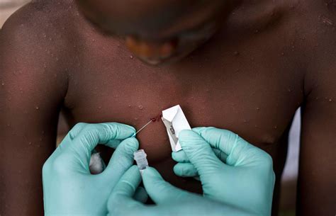 L OMS déclare que le mpox est une urgence de santé publique de portée