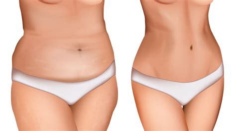 How Much Weight Can You Lose With Liposuction