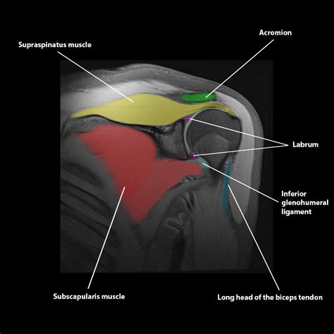 CaseStacks.com - Shoulder MRI Anatomy