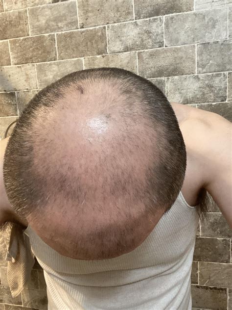 2 Months On Minoxidil 1 Week On Finasteride And 2 Months Once Every