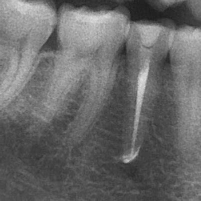 Radiograph Revealing Periapical Radiolucency Around Tooth