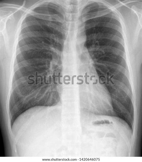 42 Lung X Ray Asbestos Images, Stock Photos & Vectors | Shutterstock