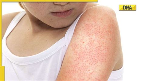 Keratosis Pilaris Follow These 4 Steps To Get A Smooth Skin