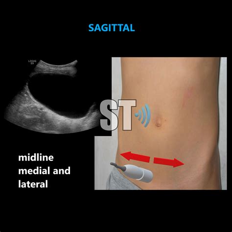 Renal Ultrasound Complete Protocol – Sonographic Tendencies