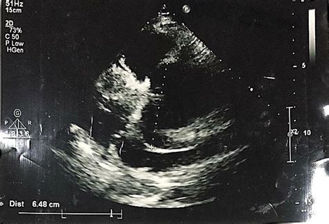 Echocardiography of aortic root with its noticing diameter (64 mm ...