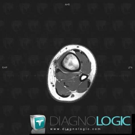 Radiology Case Stress Fracture Mri Diagnologic