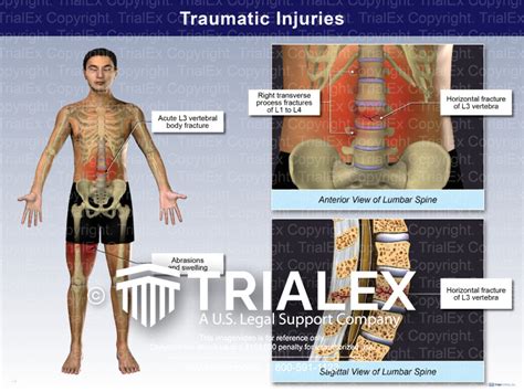 Traumatic Injuries Trial Exhibits Inc