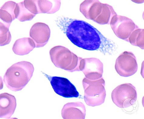 Splenic Marginal Zone Lymphoma With Villous Lymphocytes – Peripheral Blood - 6.