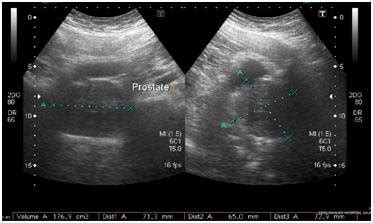 Normal Prostate Volume Ultrasound | Hot Sex Picture