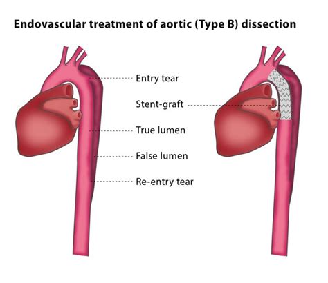 Endovascular Treatment Of Aortic Dissections Cirse