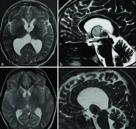 Colloid Cyst On Mri Variable T2 Signal A Hyper B Hyper C Iso Download Scientific