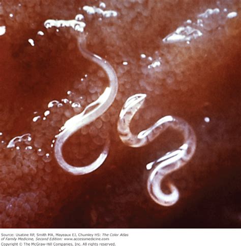 Intestinal Worms And Parasites Basicmedical Key