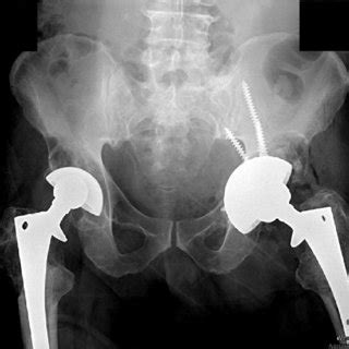 Postoperative Anteroposterior Pelvis Radiograph Demonstrating Ilium