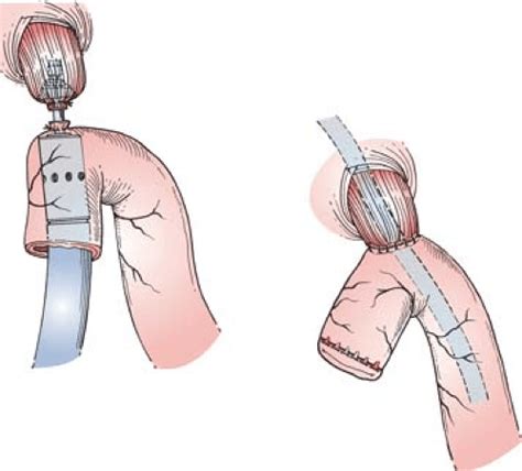 Gastric Resection Basicmedical Key