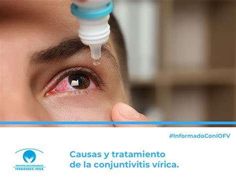 Conjuntivitis Vírica Estos Son Los Tratamientos Y Las Causas