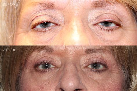 Ptosis Repair Before And After Photos Kirkland Bellevue Marina Park