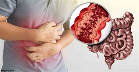 DIAGRAM Diagram Of Crohns Disease MYDIAGRAM ONLINE