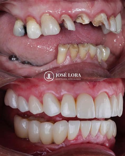 Implantes Dentales Precios Econ Micos En Colombia Odontologo Dr Jose