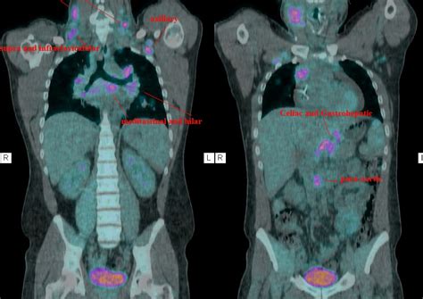 Kicking the Hodge: PET Scan Results