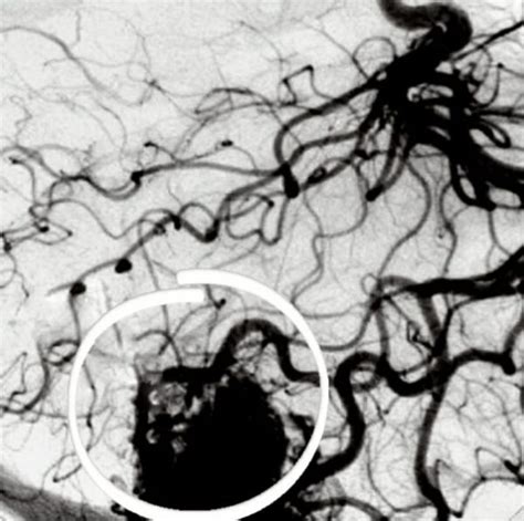 Malformaci N Arteriovenosa Mav Causas Y Tratamiento